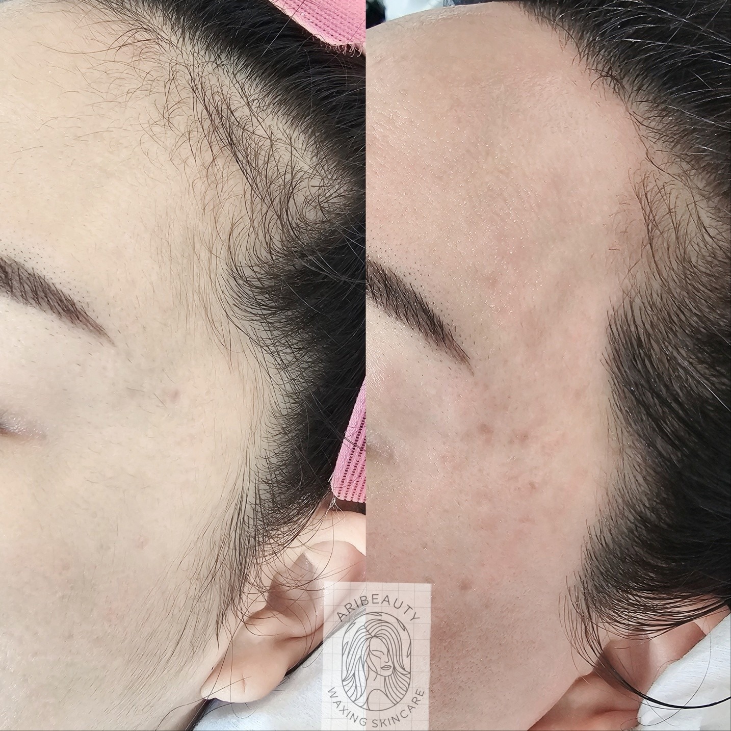 Ari Beauty(아리뷰티&왁싱) / 이건 결혼식 전 필수시술!! 경기도 의정부시 용현동 비즈프로필