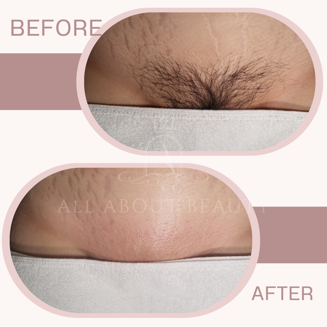 3월 17일,18일] 단 2일!! /브라질리언왁싱 50%+5천원 추가할인 | 충청북도 청주시 흥덕구 가경동 | 왁싱 | 당근 비즈 소식