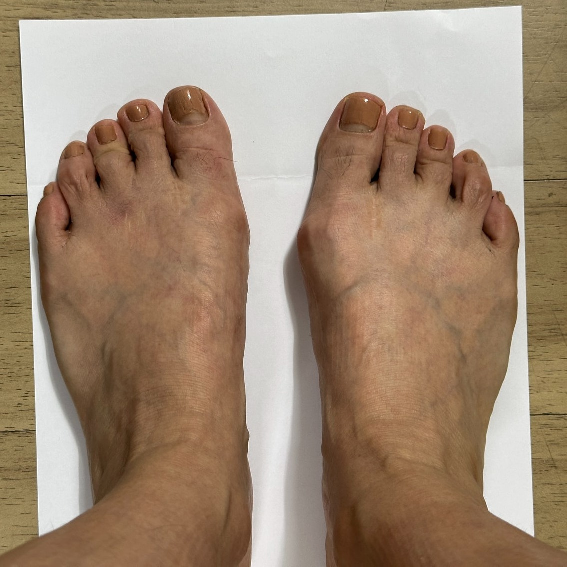무지외반증 수술 4년째, 맞춤 신발 제작 후기 - 부산광역시 부산진구 개금동 | 비즈프로필 무지외반증 수술 4년째, 맞춤 신발 제작 후기 - 부산광역시 부산진구 개금동 | 비즈프로필