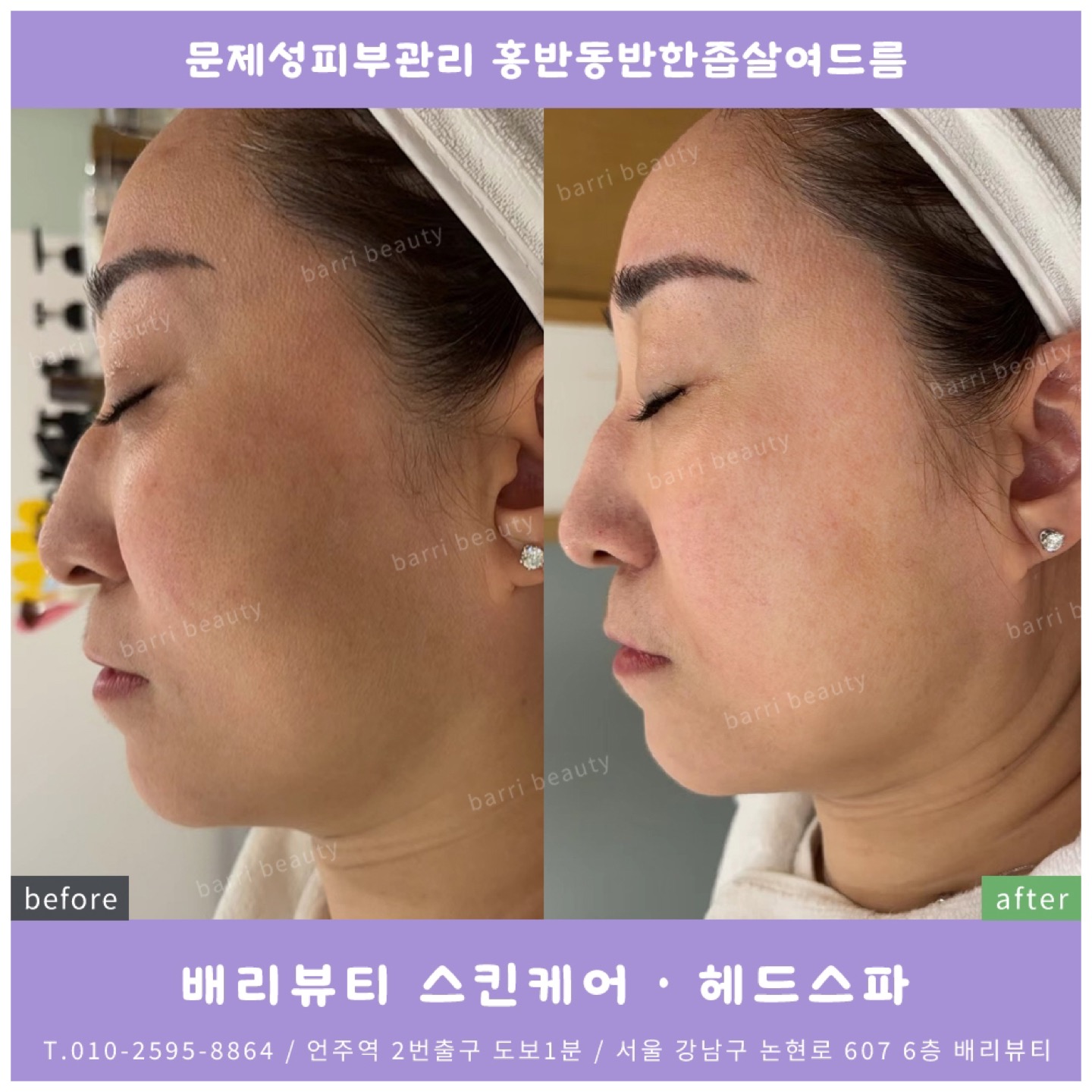 강남 아토피 관리? 2가지 핵심 방법 공개