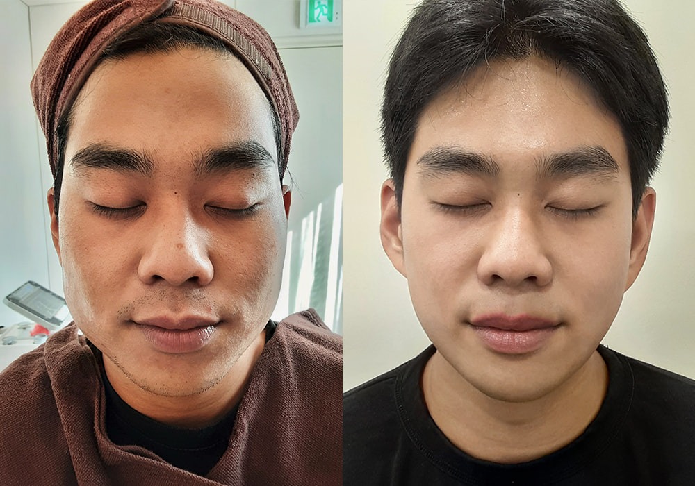 턱살 이중턱 볼살처짐으로 고민이신분들만보세요(남자) - 서울특별시 강남구 청담동 | 비즈프로필