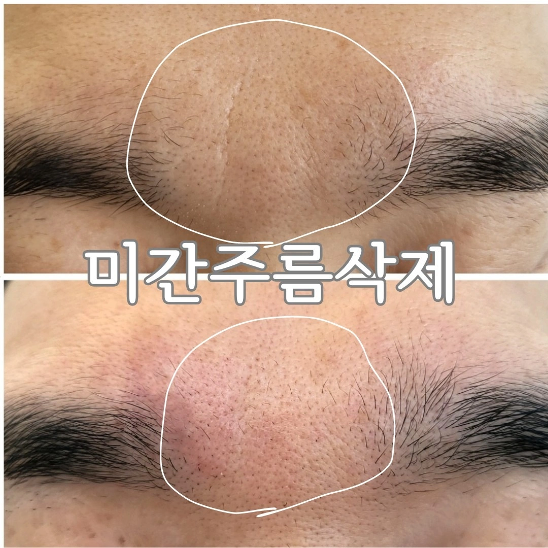 보기싫은 미간 주름 한방에 해결! | 대구광역시 수성구 지산동 | 뷰티 | 당근 비즈 소식