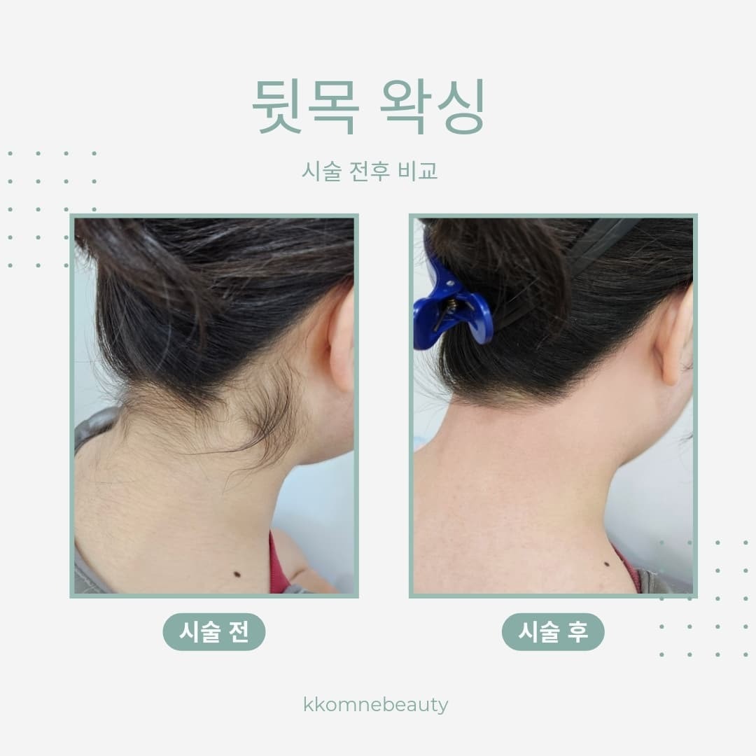핫한 여름 🌞 왁싱으로 깔끔.시원하게✨️