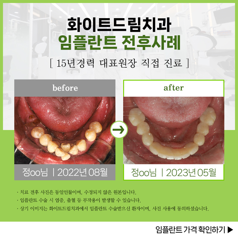 임플란트 뼈이식 가격 맞춤형 기준 요약 임플란트 뼈이식 가격 맞춤형 기준 요약