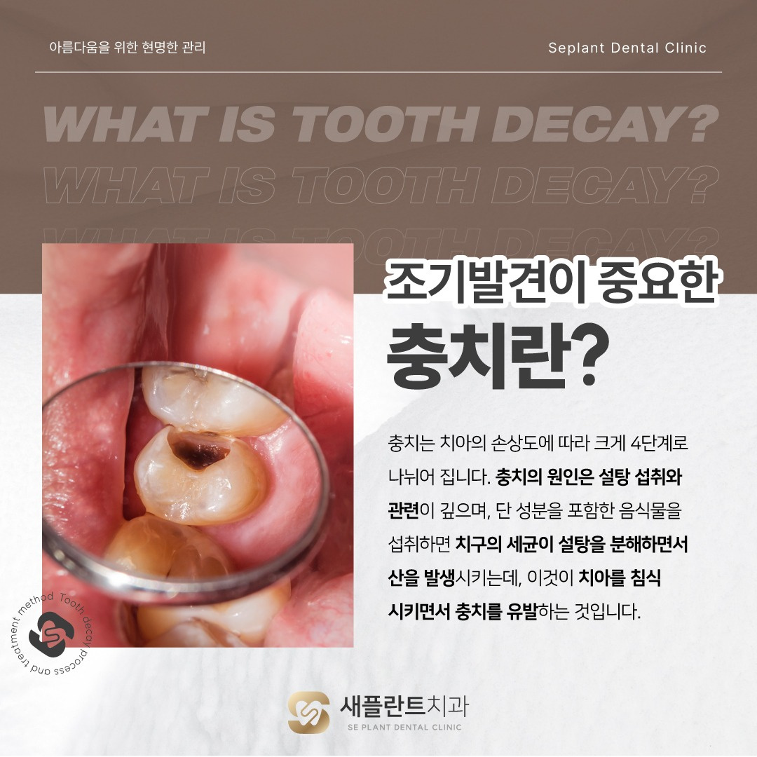 충치 진행과정 및 치료방법! 🦷 - 서울특별시 중랑구 망우동 | 비즈프로필 충치 진행과정 및 치료방법! 🦷 - 서울특별시 중랑구 망우동 | 비즈프로필