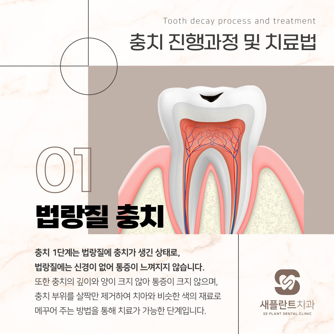 충치 진행과정 및 치료방법! 🦷 - 서울특별시 중랑구 망우동 | 비즈프로필 충치 진행과정 및 치료방법! 🦷 - 서울특별시 중랑구 망우동 | 비즈프로필