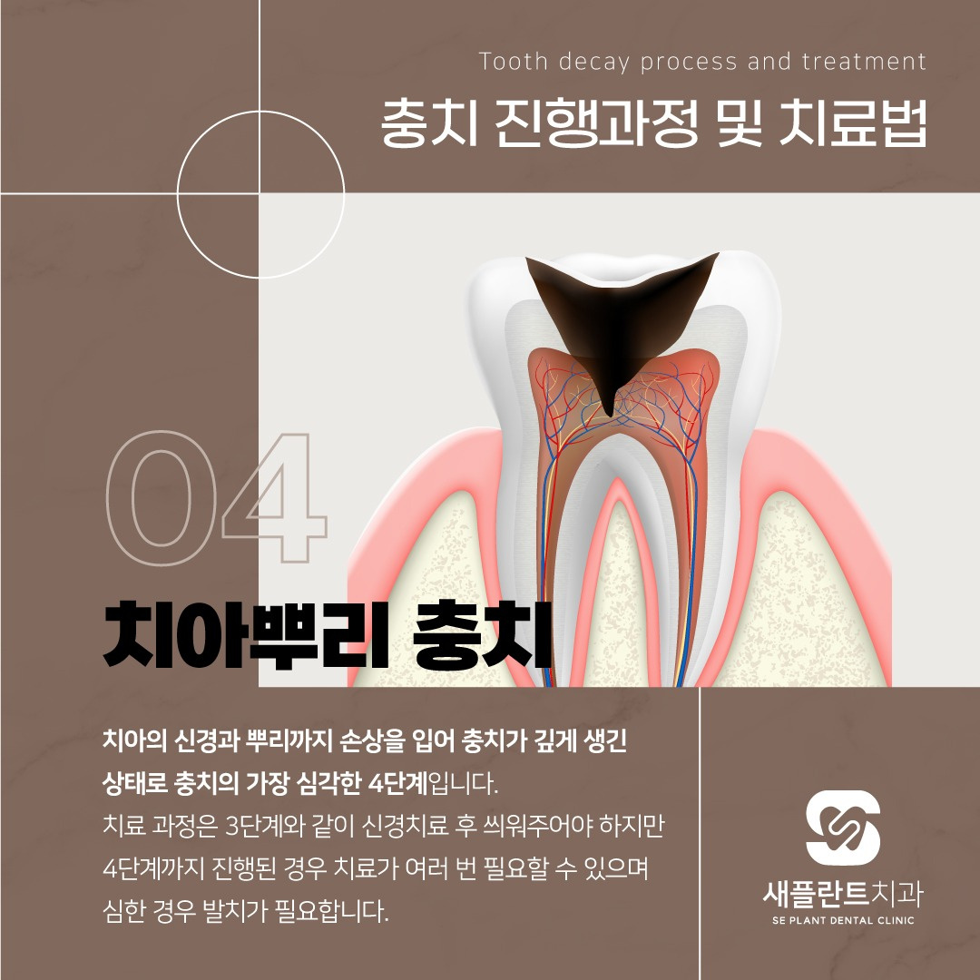 충치 진행과정 및 치료방법! 🦷 - 서울특별시 중랑구 망우동 | 비즈프로필 충치 진행과정 및 치료방법! 🦷 - 서울특별시 중랑구 망우동 | 비즈프로필