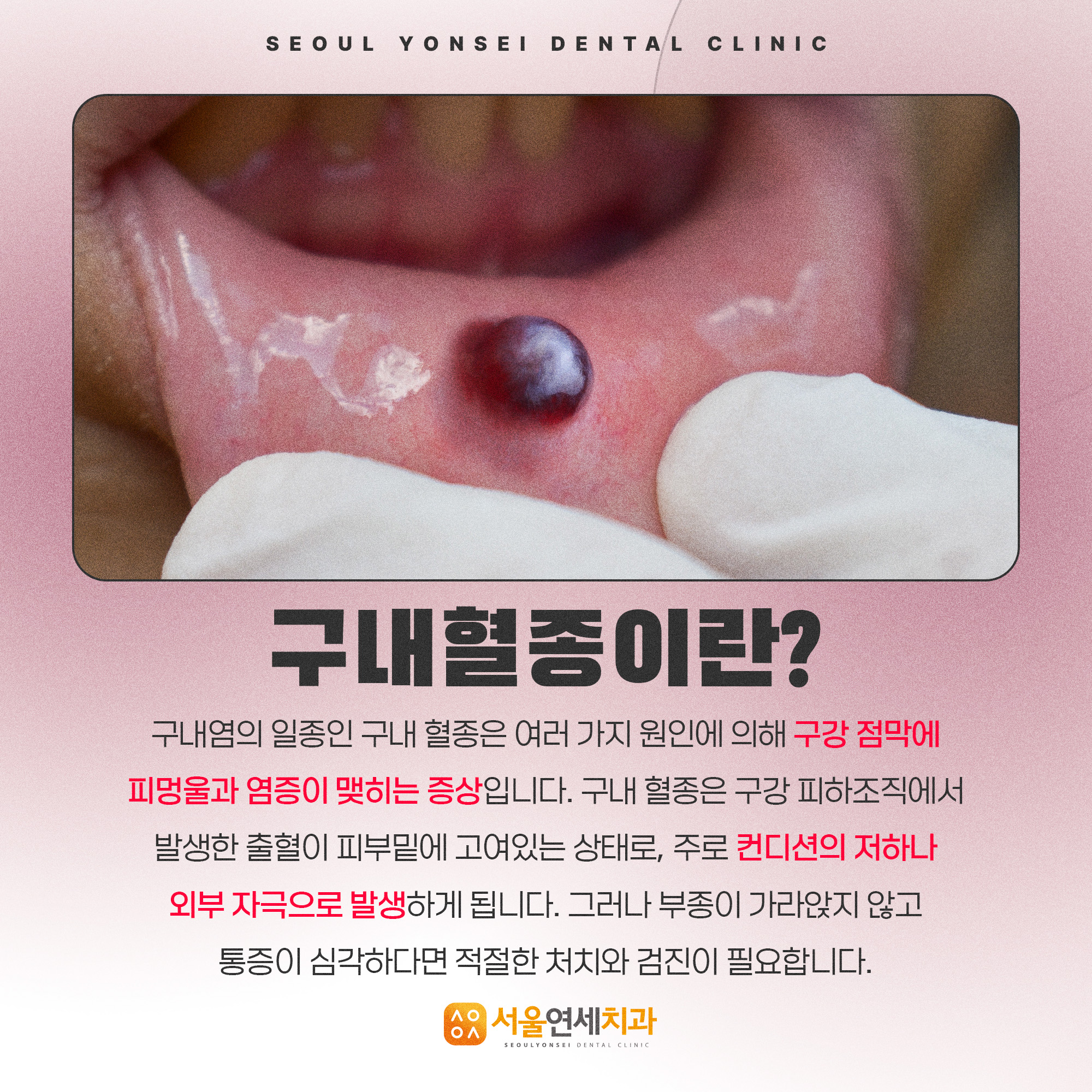 입안에 생기는 피멍울 구내혈종이란? - 경상북도 경주시 황성동 | 비즈프로필