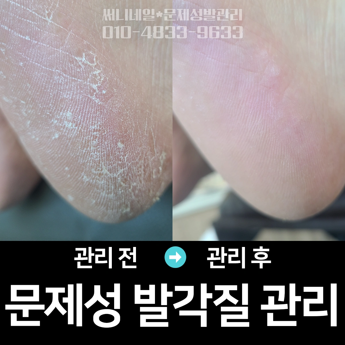 40대 남성 발 전체 관리_수포 발 각질 제거 - 부산광역시 기장군 일광읍 | 비즈프로필