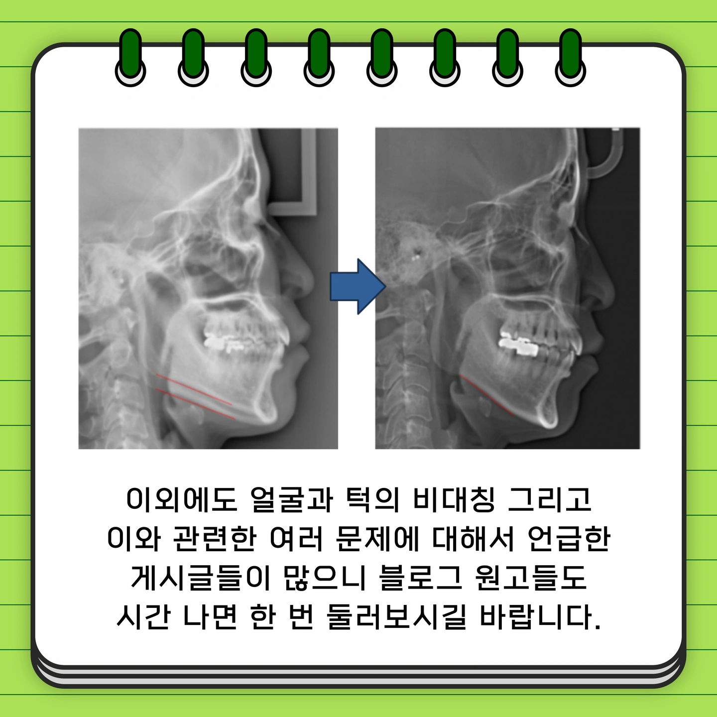 턱비대칭 교정, 턱 틀어짐을 잡아야 한다. | 서울특별시 강남구 논현동 | 치과의원 | 당근 비즈 소식