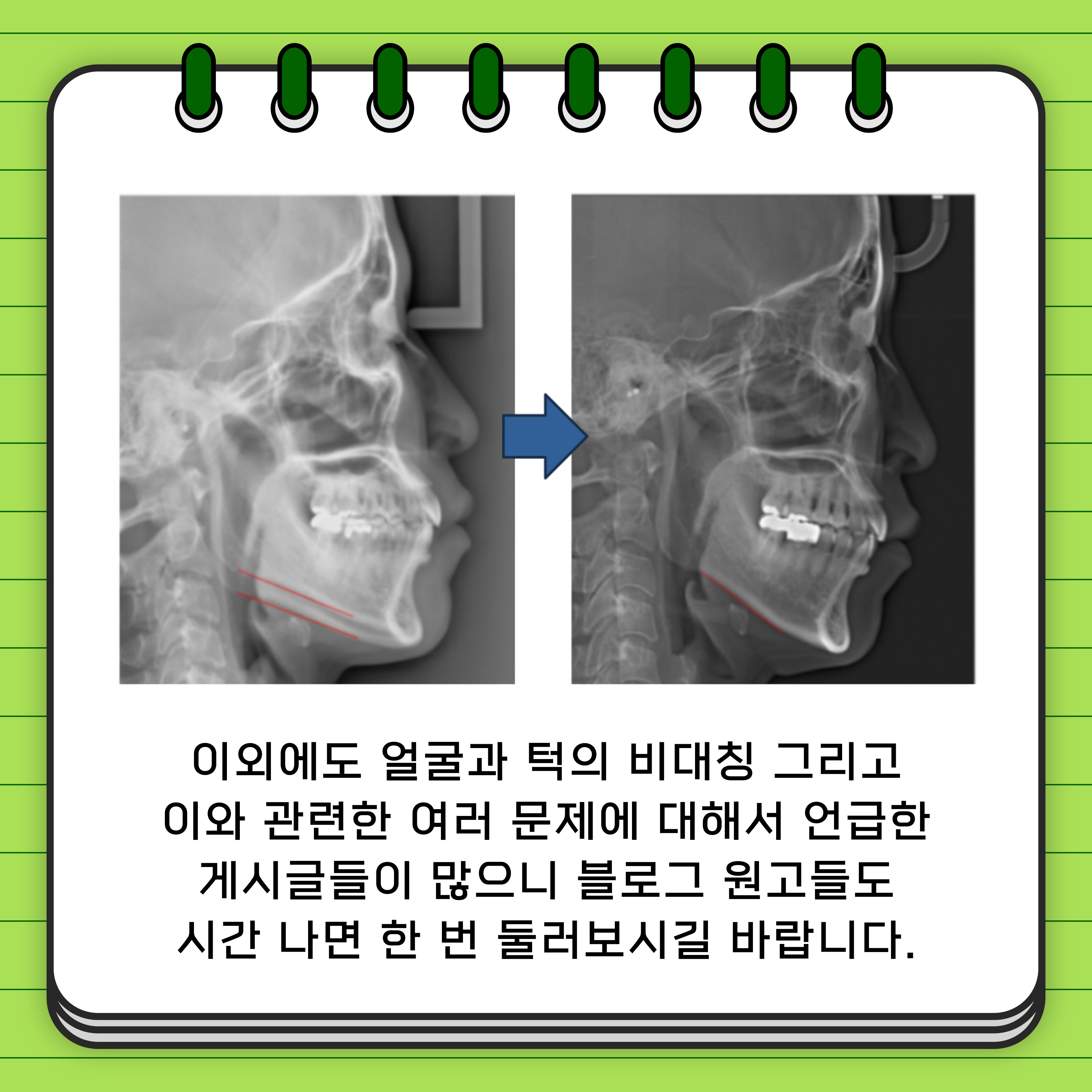 턱비대칭 교정, 턱 틀어짐을 잡아야 한다. | 서울특별시 강남구 논현동 | 치과의원 | 당근 비즈 소식