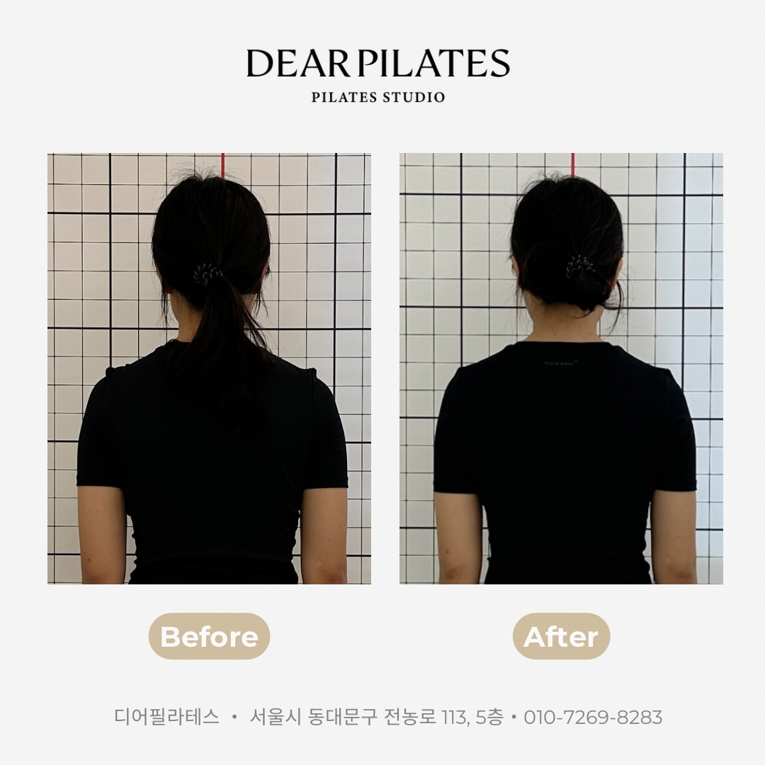 💢솟은 승모근💢 필라테스로 해결🧡