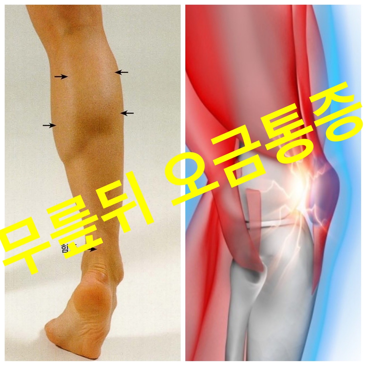 무릎뒤 오금 통증에 대해 알아보자~ - 충청북도 청주시 상당구 용암동 | 비즈프로필