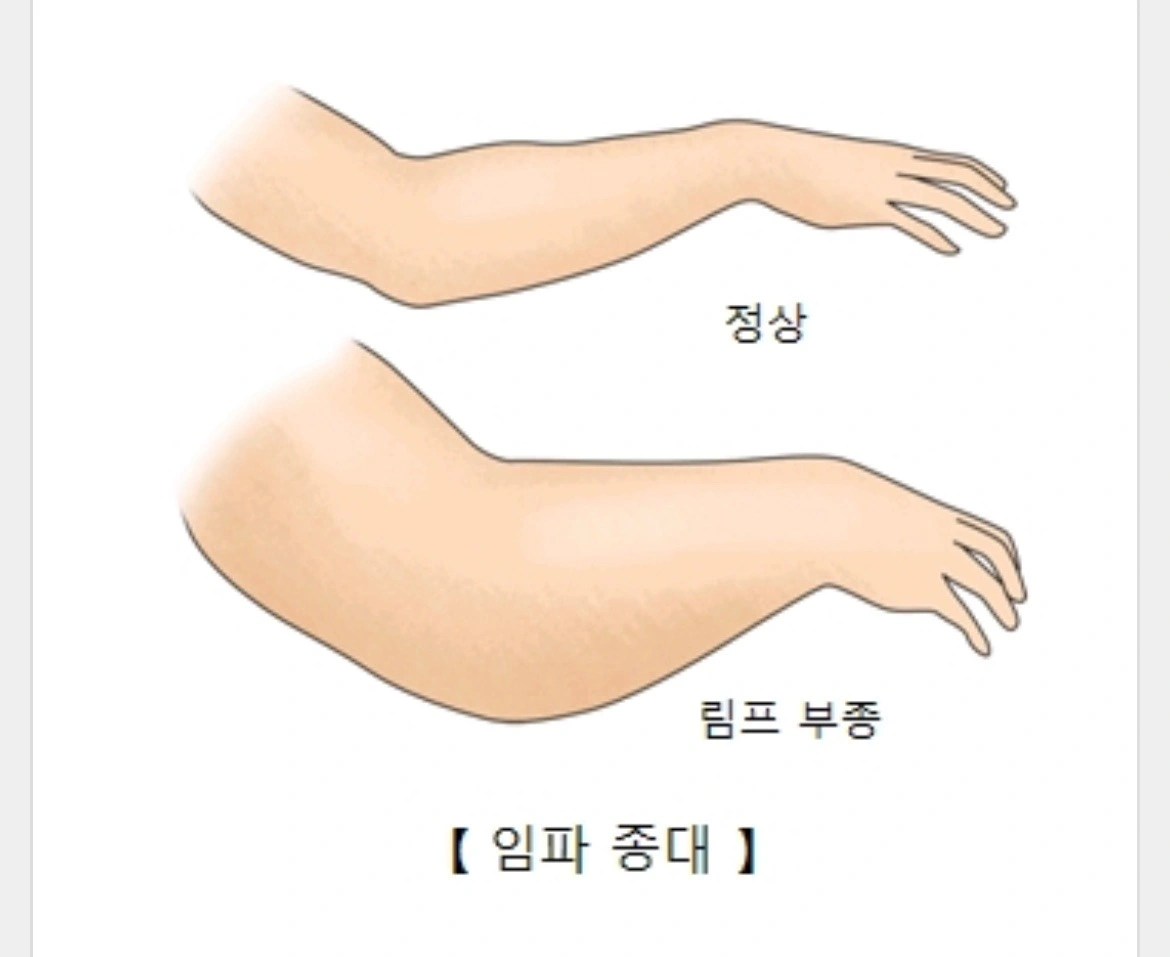 유방암 림프 부종 고통에서 벗어 나는 방법 - 경기도 구리시 인창동 | 비즈프로필