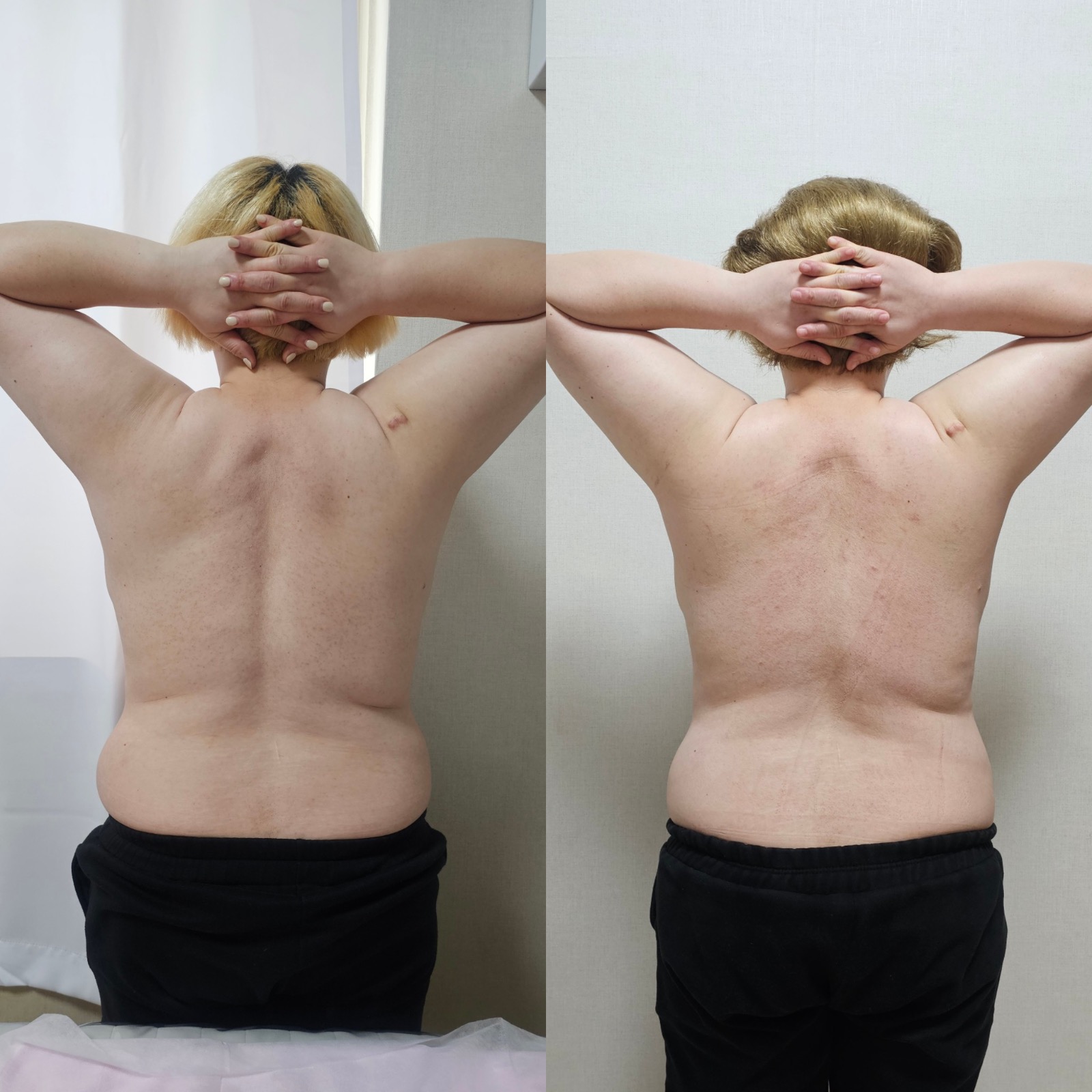 더슬림 림프순환 picture 6