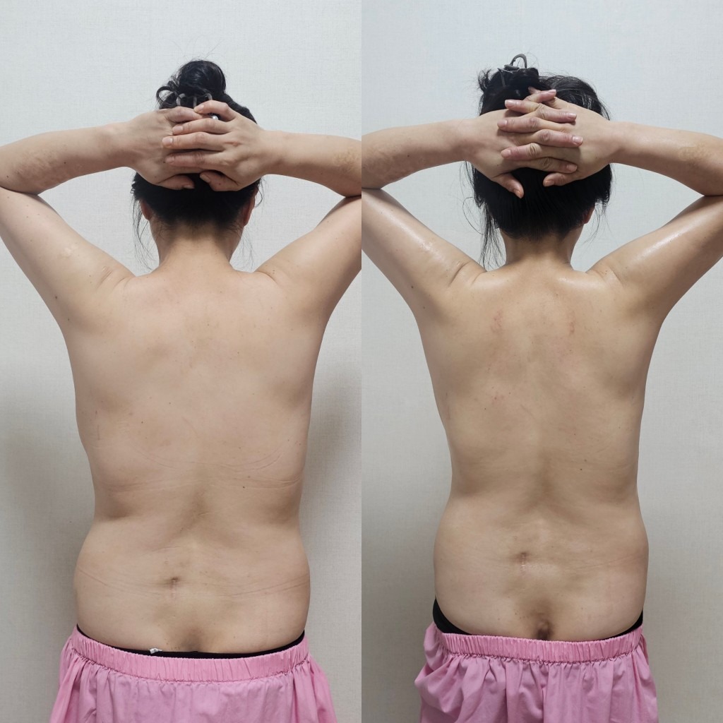 더슬림 림프순환 picture 3