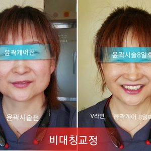 울쎄라 써마지 고주파석션기 각종 미용기기관리샵