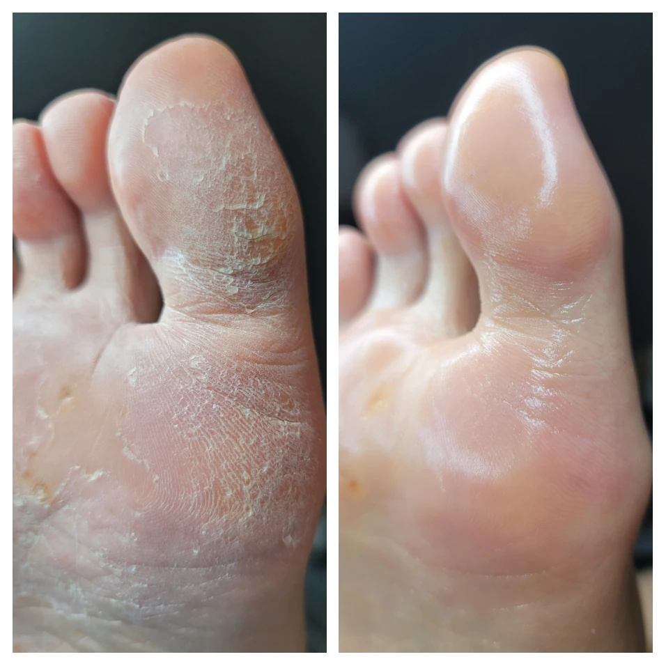 울산 발관리 발각질 굳은살 관리 1