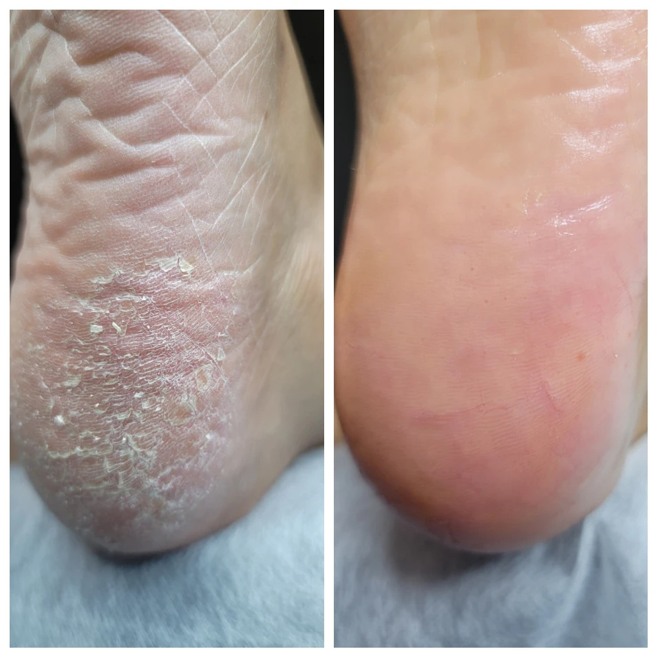 울산 발관리 발각질 굳은살 관리 2