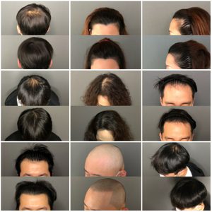헤어라인, 가르마, M자탈모, 정수리탈모, 흉터커버 탈모 고민 해결해 드립니다