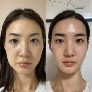 피부관리 .여드름관리 .등관리 .두피관리.건선.아토피