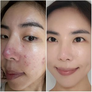 피부관리 및 피부컨설팅 선착순 5명-주름, 모공고민,기미,동안피부 원하시는분