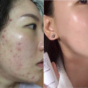 피부관리 및 피부컨설팅 선착순 5명-주름, 모공고민,기미,동안피부 원하시는분