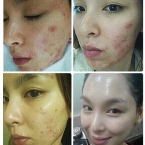 피부관리 및 피부컨설팅 선착순 5명-주름, 모공고민,기미,동안피부 원하시는분